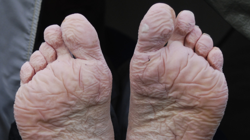 photo of someone with trench foot