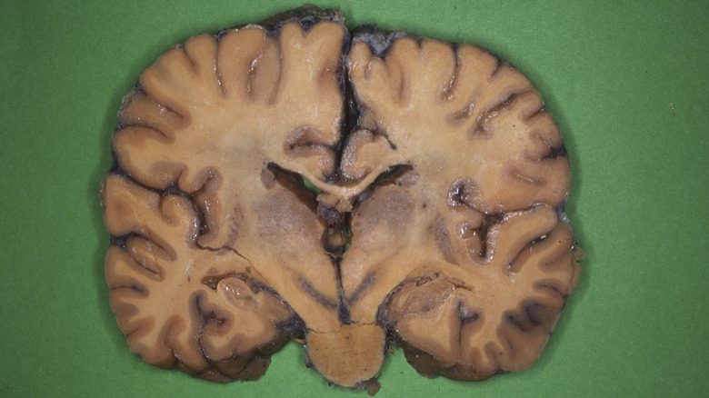 slice of human brain