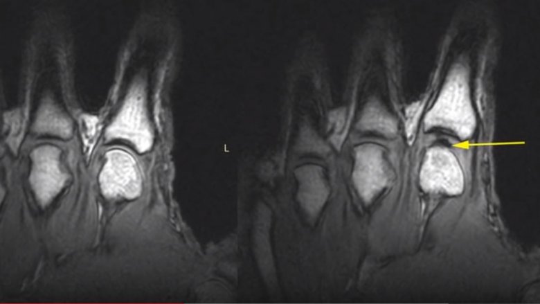 synovial fluid knuckle crack pop cavity