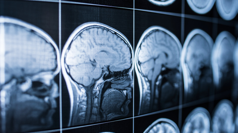 Stock photo of brain scan