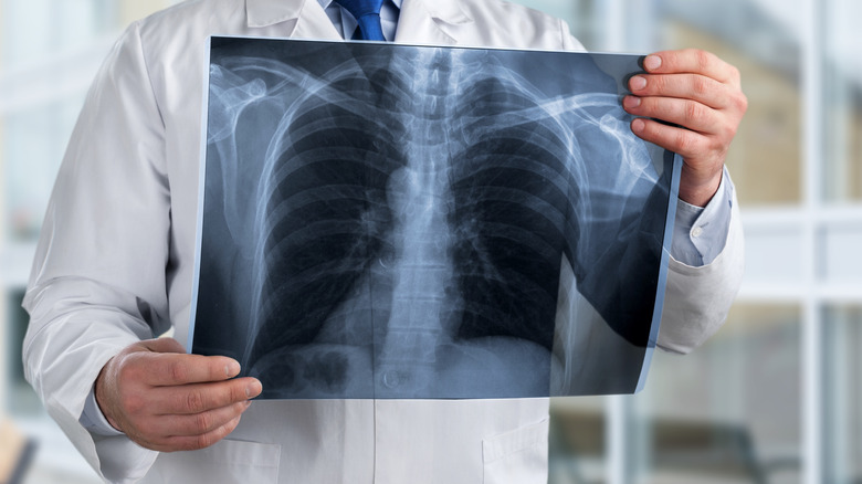 Doctor holding lung X-ray