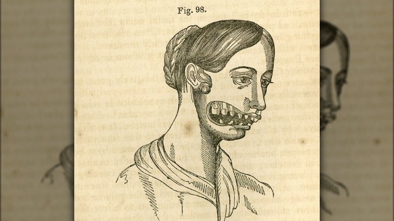 Phossy jaw illustration