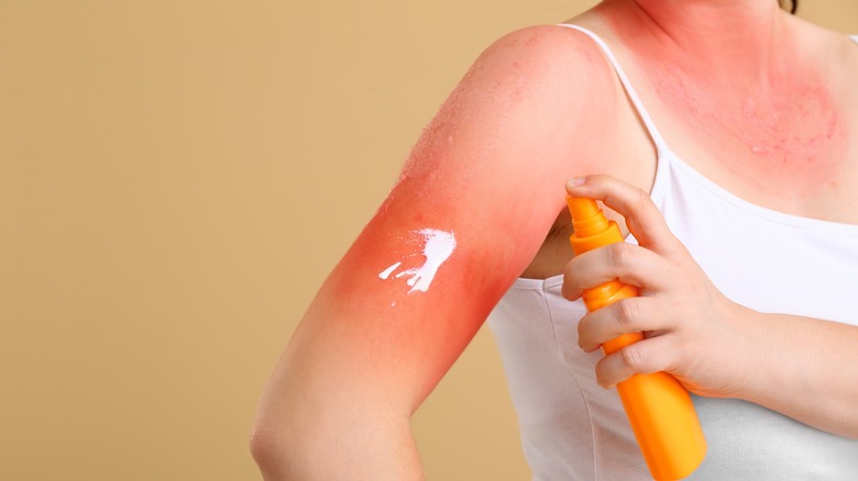 sunburn on arm
