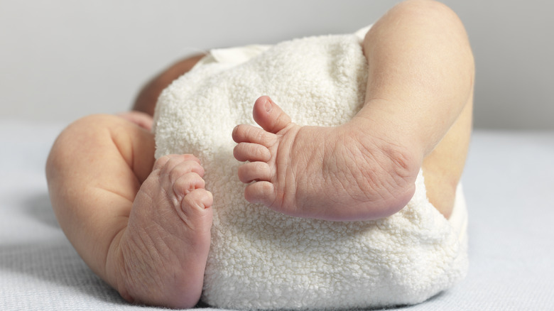 baby with clubbed foot