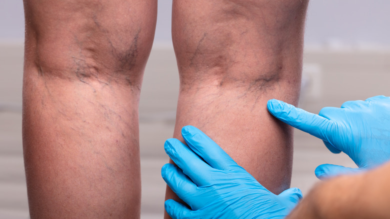 Doctor pointing at varicose veins