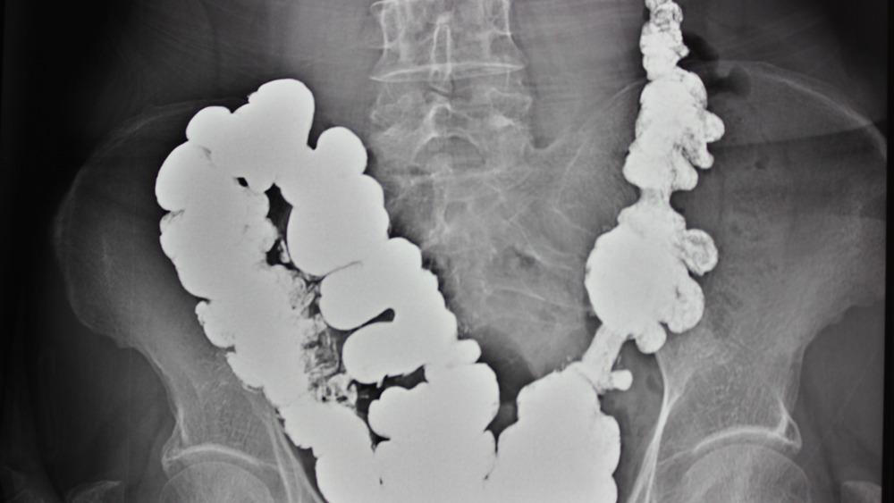 X-ray image of diverticulitis 