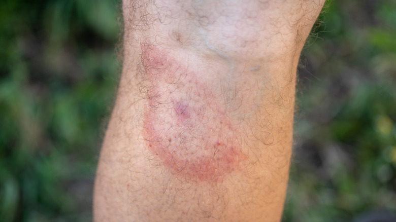 Lyme disease bulls-eye rash