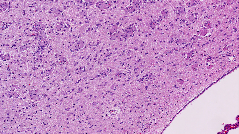 krabbe's disease cell