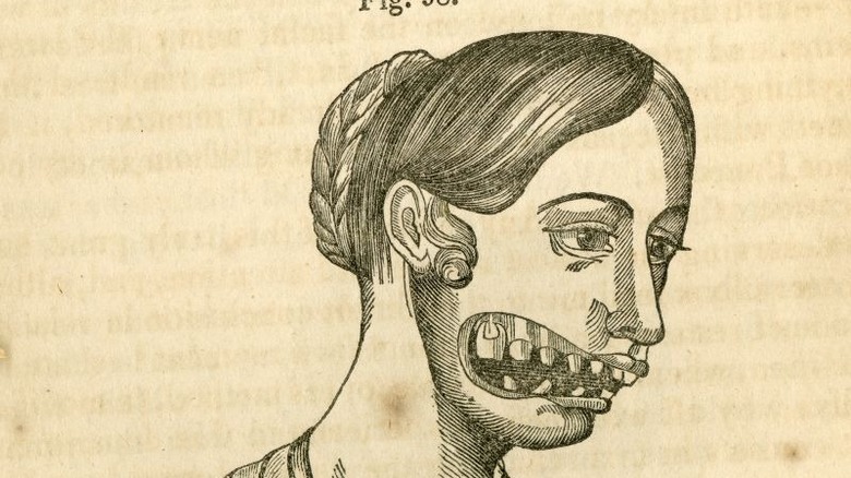 Drawing of phossy jaw from 19th century