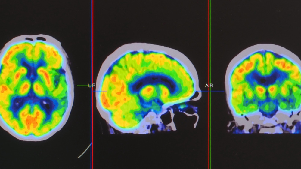 Positron emission tomography (PET) 